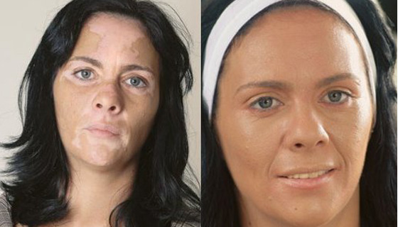 Vitiligo Tedavisi Öncesi - Sonrası