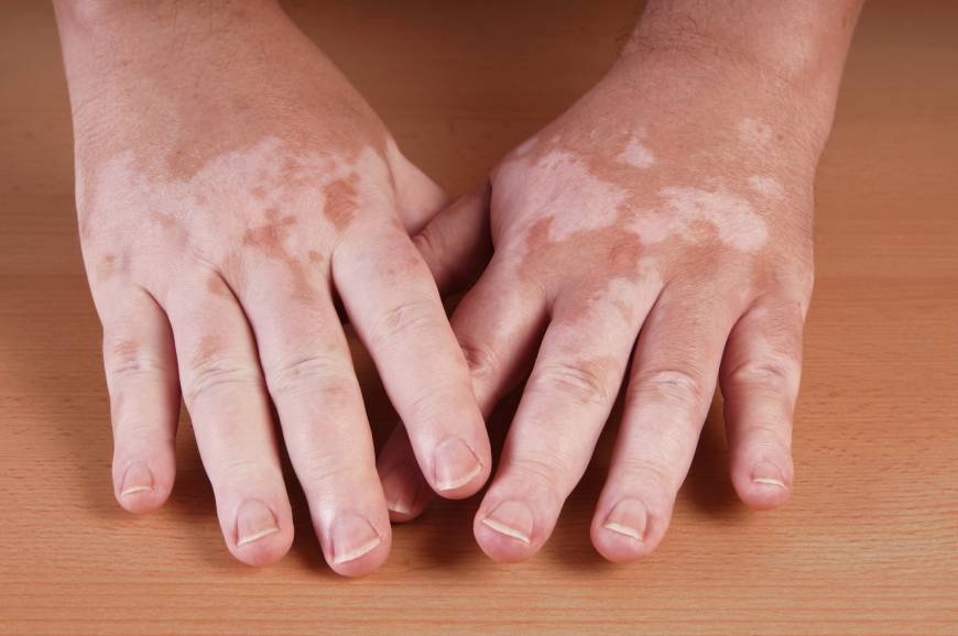 Vitiligo Hastalığı ve Tedavisi