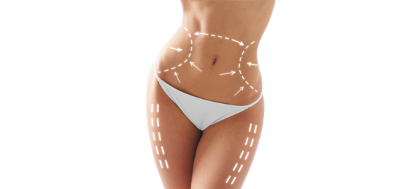 Liposuction